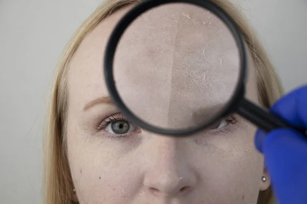 Een Vrouw Onderzoekt Droge Huid Haar Gezicht Schillen Grof Worden — Stockfoto