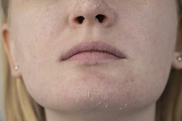 Woman Examines Dry Skin Her Face Peeling Coarsening Discomfort Skin — Stock Photo, Image