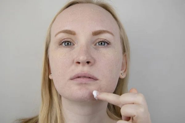 Een Vrouw Onderzoekt Droge Huid Haar Gezicht Schillen Grof Worden — Stockfoto