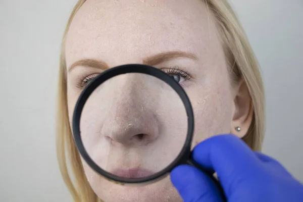 Een Vrouw Onderzoekt Droge Huid Haar Gezicht Schillen Grof Worden — Stockfoto