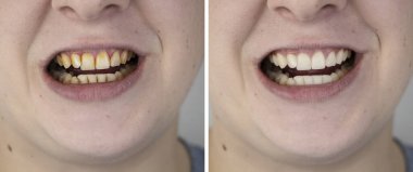 Beyazlatılmadan önce ve sonra bir adamın dişleri. Diş hekimi diş minesinden sarı plaketi çıkardı. Profesyonel diş fırçası konsepti.