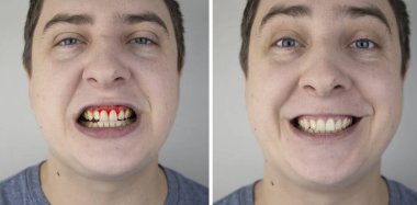 A man has gum bleeding. Photos before and after treatment of periodontitis, gingivitis and bleeding gums. The concept of prevention of oral diseases and treatment by a periodontist clipart