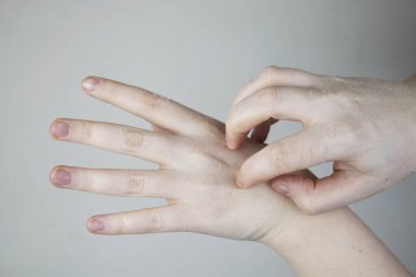 Kuru eller, derinin soyulması, mikoz. Kız ellerini bir doktor dermatoloğa gösteriyor. Elleri nemlendiriyor ve parmaklardaki mantarı tedavi ediyor.