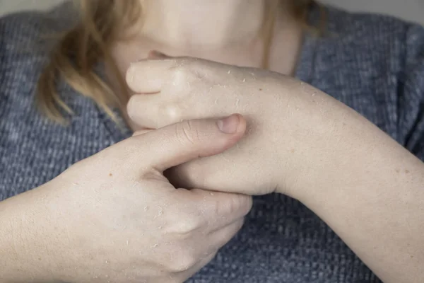 乾燥した手と皮膚の剥離 真菌症 少女は医者の皮膚科医に手を見せる 手を湿らせ 指で真菌を治療する — ストック写真