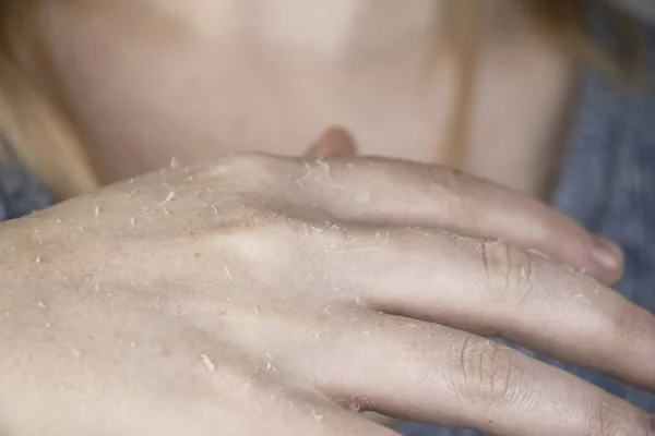 Dry Hands Peeling Skin Mycosis Girl Shows Her Hands Doctor — Stock Photo, Image