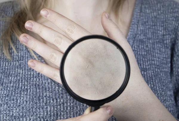 皮肤剥皮 真菌病 这个女孩向一位皮肤科医生展示她的双手 用手部保湿 用手指治疗真菌 — 图库照片
