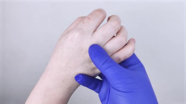 Kuru Eller Derinin Soyulması Mikoz Kız Ellerini Bir Doktor Dermatoloğa — Stok video