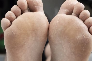 Bacağındaki mantar, beyaz arka planda izole edilmiş. Dermatoloji konsepti, mantar enfeksiyonları ve mantar hastalıklarının tedavisi. Bir adamın ayağında insan parazitlerinin makro fotoğrafı..