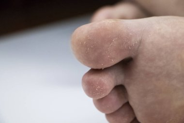 Bacağındaki mantar, beyaz arka planda izole edilmiş. Dermatoloji konsepti, mantar enfeksiyonları ve mantar hastalıklarının tedavisi. Bir adamın ayağında insan parazitlerinin makro fotoğrafı..