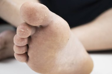 Bacağındaki mantar, beyaz arka planda izole edilmiş. Dermatoloji konsepti, mantar enfeksiyonları ve mantar hastalıklarının tedavisi. Bir adamın ayağında insan parazitlerinin makro fotoğrafı..