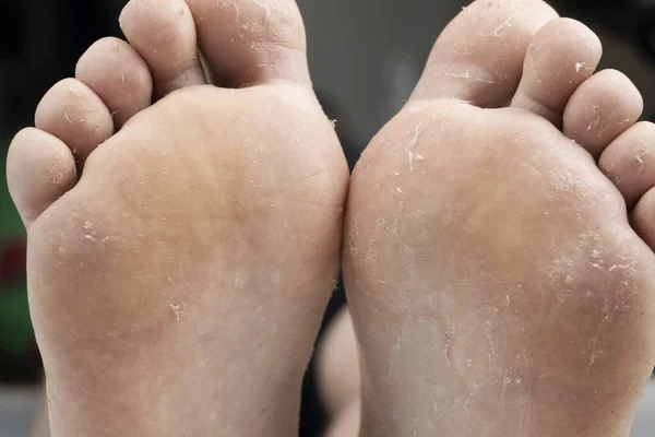 Bacağındaki Mantar Beyaz Arka Planda Izole Edilmiş Dermatoloji Konsepti Mantar — Stok fotoğraf