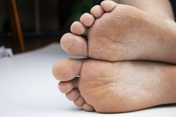 Fungus on the leg close-up isolated on a white background. The concept of dermatology, the treatment of fungal infections and ringworm. Macro photo of human parasites on the foot of a man.