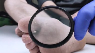 Mavi eldivenli bir doktor hastaların bacağındaki mantarı büyüteçle inceliyor. Hastanenin muayenesi. Ayak mantarının makro videosu.