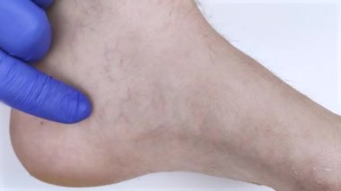 Bir damar cerrahıyla görüşen bir adam. Bir doktor şişmiş damarları olan bir bacağı muayene eder. Bacağında varis damarları var.