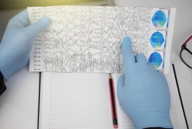 Bir nörolog hasta beyninin ensefalogramını inceler. Elektroensefalogram programı, epilepsi belirtileri ve sinir sisteminin patolojileri için beyin akımlarını incelemek.