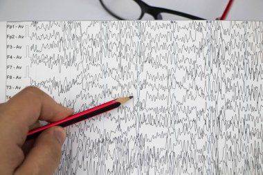 Bir nörolog hasta beyninin ensefalogramını inceler. Elektroensefalogram programı, epilepsi belirtileri ve sinir sisteminin patolojileri için beyin akımlarını incelemek.