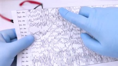 Bir nörolog hasta beyninin ensefalogramını inceler. Elektroensefalogram programı, epilepsi belirtileri ve sinir sisteminin patolojileri için beyin akımlarını incelemek.