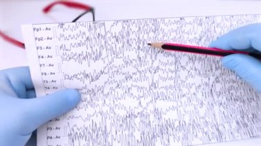 Bir nörolog hasta beyninin ensefalogramını inceler. Elektroensefalogram programı, epilepsi belirtileri ve sinir sisteminin patolojileri için beyin akımlarını incelemek.