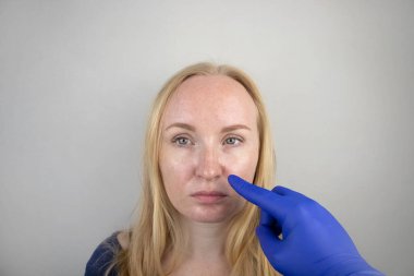 Yağlı ve sorunlu cilt. Sivilceli, yağlı ciltli ve pigmentasyonlu sarışın bir kızın portresi.