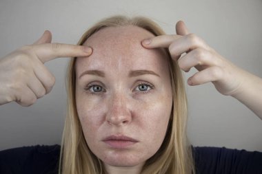 Oily and problem skin. Portrait of a blonde girl with acne, oily skin and pigmentation clipart