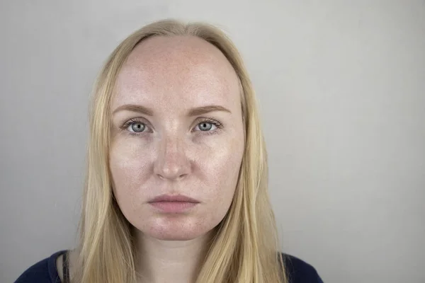 Oily and problem skin. Portrait of a blonde girl with acne, oily skin and pigmentation