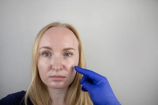 Vette Probleemhuid Portret Van Een Blond Meisje Met Acne Vette — Stockfoto