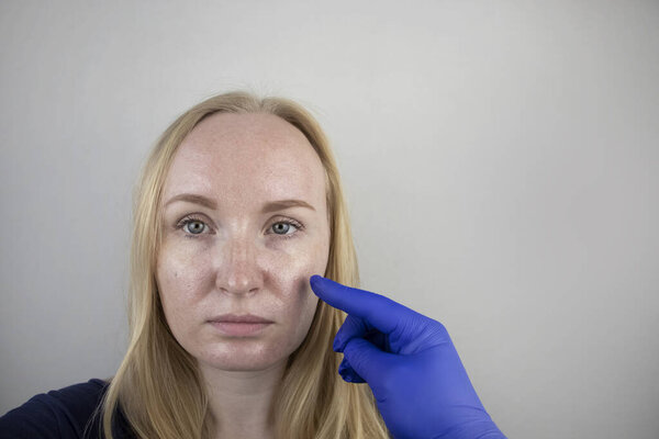 Жирная и проблемная кожа. Портрет блондинки с акне, жирной кожей и пигментацией
