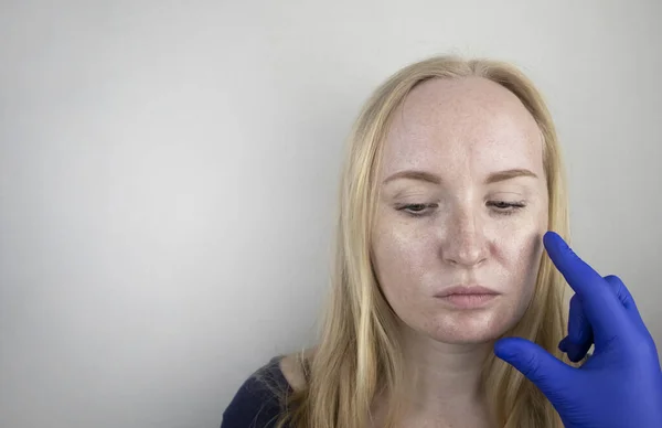 Tłusta Problematyczna Skóra Portret Blondynki Trądzikiem Tłustą Skórą Pigmentacją — Zdjęcie stockowe