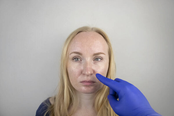 Жирная и проблемная кожа. Портрет блондинки с акне, жирной кожей и пигментацией
