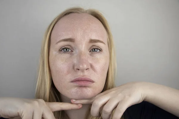 Tłusta Problematyczna Skóra Portret Blondynki Trądzikiem Tłustą Skórą Pigmentacją — Zdjęcie stockowe
