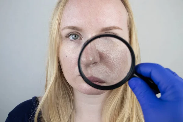 Oily and problem skin. Portrait of a blonde girl with acne, oily skin and pigmentation