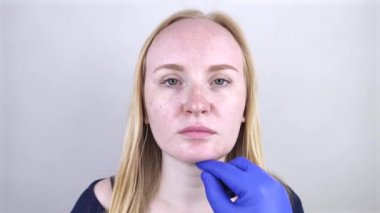 Mavi eldivenli bir dermatolog yağlı cildini muayene ediyor. Yağlı ve sorunlu cilt. Sivilceli, yağlı ciltli ve pigmentasyonlu sarışın bir kızın portresi..