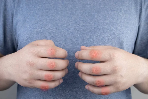 Hombre Crece Dedos Que Duelen Tiran Artritis Artrosis Las Articulaciones —  Fotos de Stock