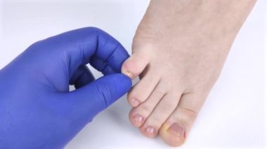 Doktor podolojist kadın ayağının üzerindeki tırnak mantarını inceliyor. Onikomikozis tedavisi, mikoz. Deforme olmuş tırnak plakası