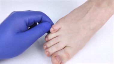 Doktor podolojist kadın ayağının üzerindeki tırnak mantarını inceliyor. Onikomikozis tedavisi, mikoz. Deforme olmuş tırnak plakası