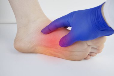 Bir ortopedi doktoru bir kadının bacağını muayene eder. Topuk ağrısı, tendon gerilmesi, iltihap, topuk çıkıntısı. Ayak Hastalığı Tedavisi Konsepti