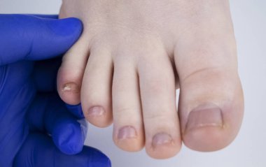 Doktor podolojist kadın ayağının üzerindeki tırnak mantarını inceliyor. Onikositoz tedavisi, mikozis..