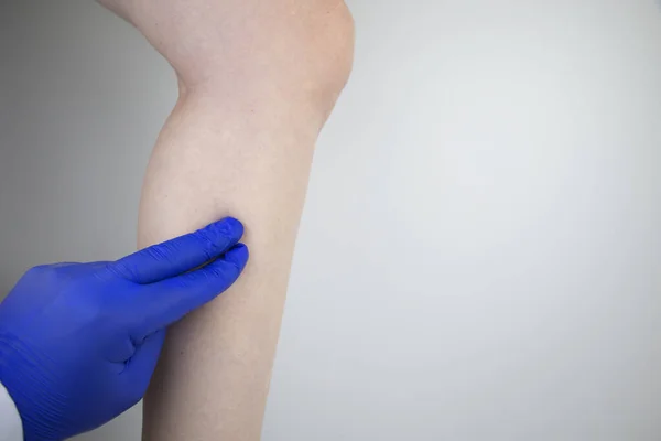 A woman suffers from pain in the calves. Stretching the calf muscle, varicose veins, leg cramps, or myositis. Orthopedic doctor examines patient — Stock Image Woman Suffers Pain Calves Stretching Calf Muscle Varicose Veins Leg Stock Picture