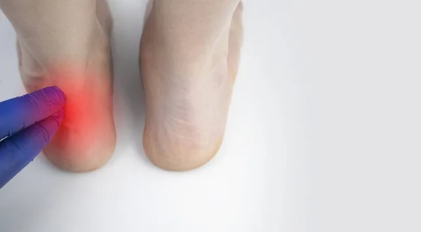35 Achilles Tendinitis Stock Photos Images Download Achilles Tendinitis Pictures On Depositphotos 35 Achilles Tendinitis Stock Photos Images Download Achilles Tendinitis Pictures On Depositphotos