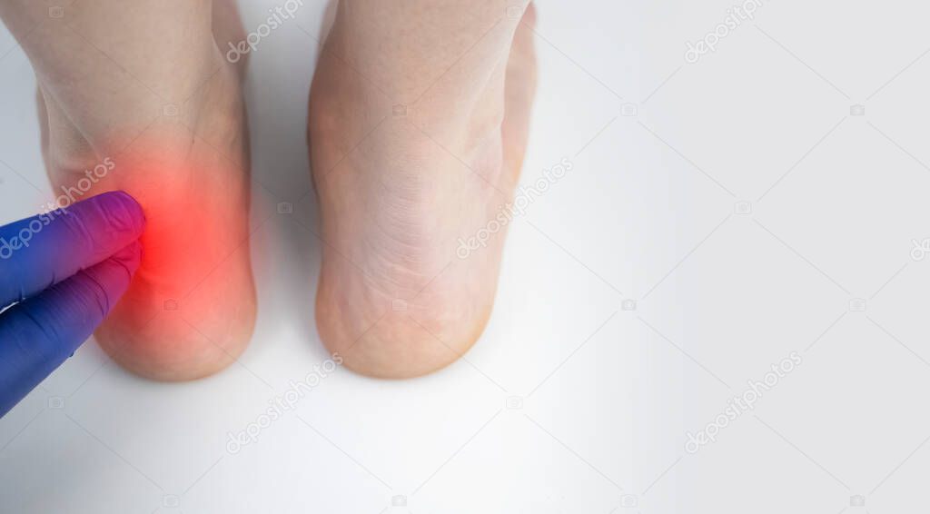 An orthopedic doctor examines a woman's leg. Achilles tendon and ankle diseases. Inflammation of the heel and foot, achillobursitis and achillotomy, rheumatism, tendon rupture
