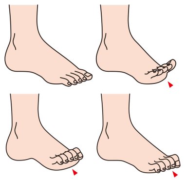 Toes.foot sorun.