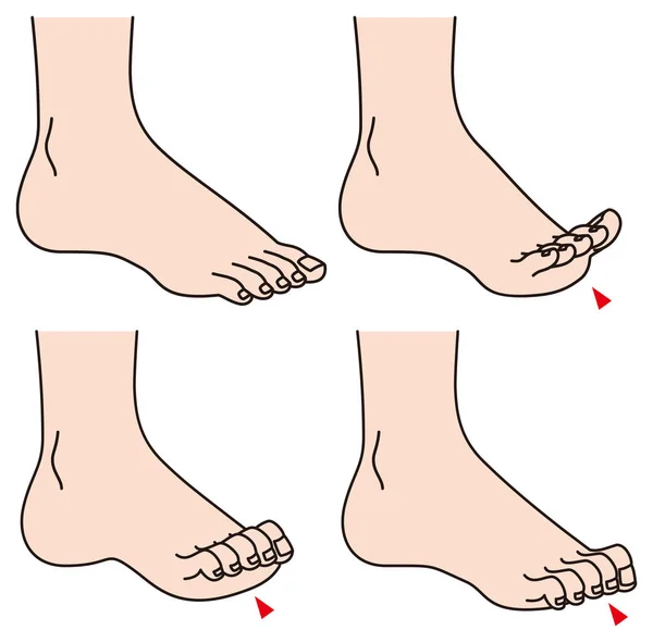 Problemas de toes.foot . —  Vetores de Stock