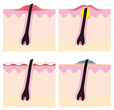 Saç dökülmesi ve görüntü sketch kendini kaldırma saç ve cilt problemleri