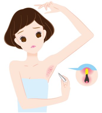 koltukaltı saç kendini pürülan cımbız iltihap için işleme