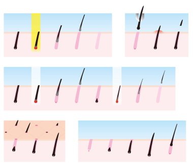 kaldırma saç; Depilasyon.