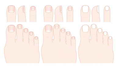 Çivi ayak. Tırnak şekli.