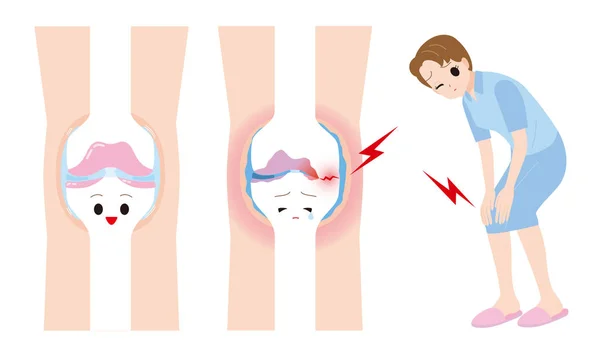 여자 관절 통 다리 — 스톡 벡터