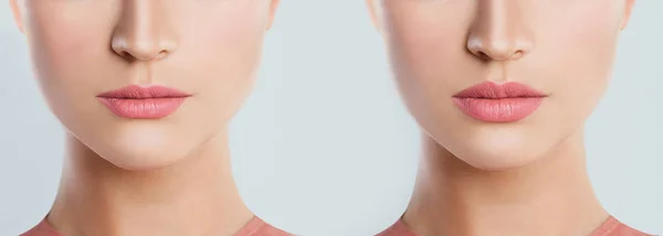 Önce ve sonra dolgu enjeksiyonları erkek dudak. Dolgu maddeleri.