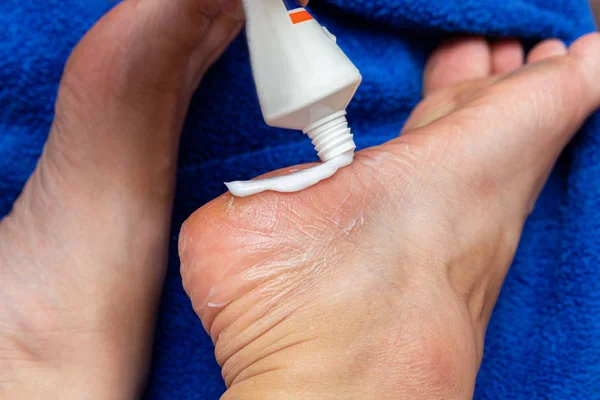 applying cream from the tube on the feet sole for the treatment of corn, callus, callosity, cracks, softening the skin, cosmetic procedures