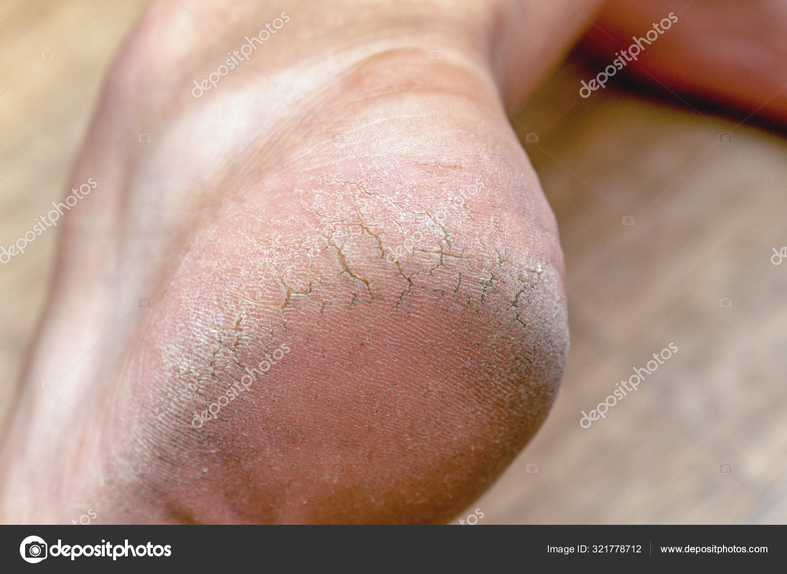 callus crack